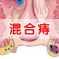 青岛肛肠医院：混合痔百科