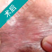 HCPT创口微小术——治肛裂微痛不出血