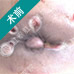 HCPT创口微小术——治肛裂微痛不出血