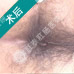 HCPT创口微小术——治肛裂微痛不出血
