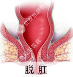 痔疮较佳治疗方法