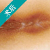 高频电镊微创术创口微小术——治肛裂微痛不出血