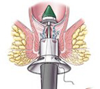 智能痔上黏膜环切吻合术治痔疮三步到位