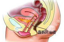 直肠阴道瘘百科
