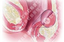 肛窦炎百科