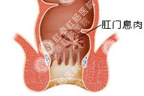 肛门息肉百科