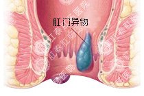 肛门异物百科