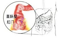 直肠恶变百科
