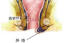 外痔百科
