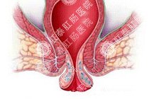 脱肛百科
