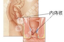 内痔百科