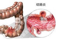 结肠炎百科