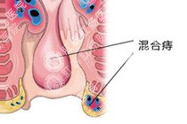 混合痔百科
