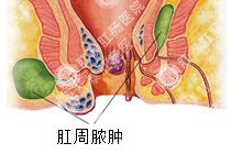 肛周脓肿百科