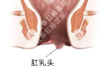 肛乳头瘤百科
