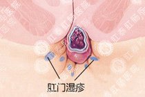 肛门湿疹百科
