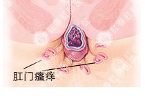 肛门瘙痒百科