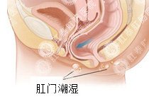 肛门潮湿百科