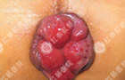 女性混合痔的治疗