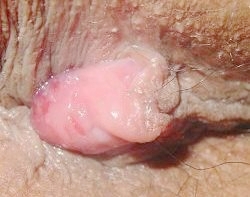 混合痔怎么治疗？