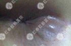 【多图】介绍肛周脓肿的
