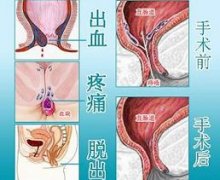 脱肛和痔疮的区别